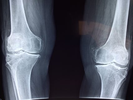 X-ray image knee
